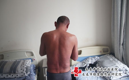 银屑病的危害表现是什么，长春银屑病医院排名。