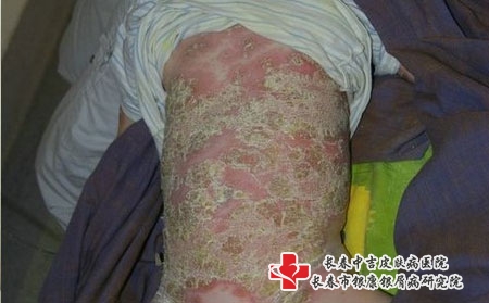 银屑病怎么治疗好，长春银屑病到底该怎样治疗?