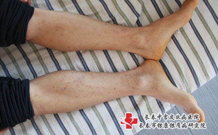 怎样治疗银屑病有助于康复，长春如何治疗银屑病?