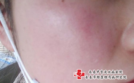 皮炎的发病因素-长春哪里治疗皮炎?