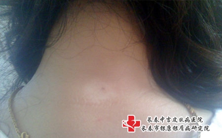 引发白癜风的主要原因是什么-长春哪里治白癜风好?