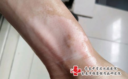 白癜风常见的危害有哪些-长春哪里治疗白癜风效果好?