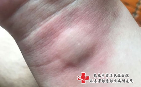 导致小孩患荨麻疹的原因-长春治荨麻疹的好医院? 导致小孩患荨麻疹的原因-长春治荨麻疹的好医院?