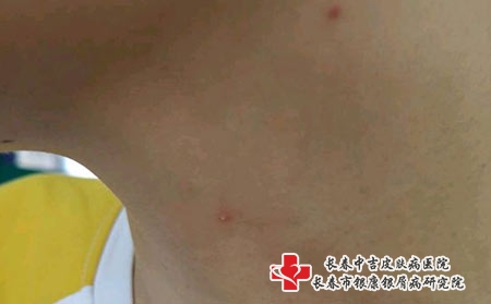 得上荨麻疹其症状有哪些-长春治荨麻疹较好的医院? 得上荨麻疹其症状有哪些-长春治荨麻疹较好的医院?