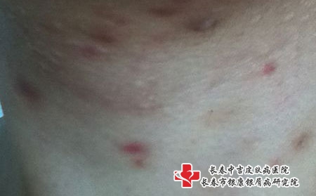 痤疮如何护理-长春治疗痤疮的好医院?