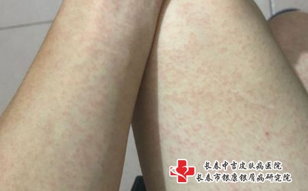 皮炎患者平时要注意什么-长春哪家医院能治皮炎?