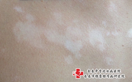 白癜风治疗禁区有哪些碰不得的?长春治疗白癜风医院排行?