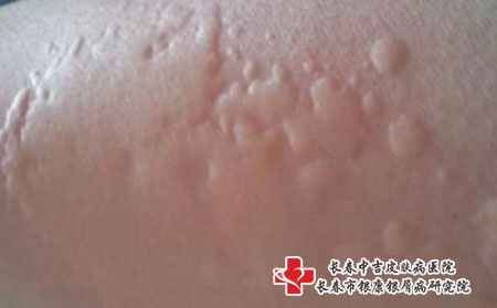 荨麻疹的预防怎么做-长春哪家医院看荨麻疹? 荨麻疹的预防怎么做-长春哪家医院看荨麻疹?