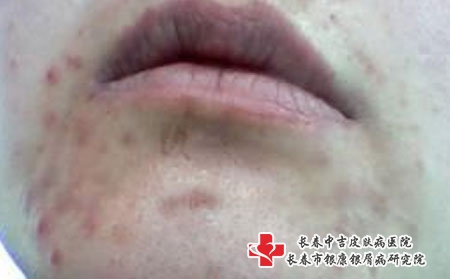 我们如何预防青春痘-长春哪里能治疗青春痘?