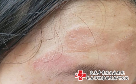 30长春哪家治疗皮炎好?什么是神经性皮炎的防治注意事项?