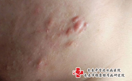 青春痘外部形成原因是什么-长春哪里医院治疗青春痘好?