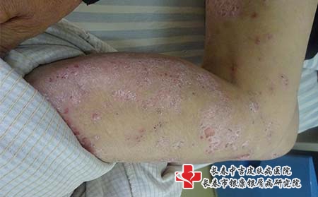 银屑病需要遵守哪些治疗原则