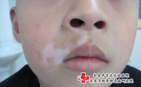 药物治疗白癜风需要注意哪些?
