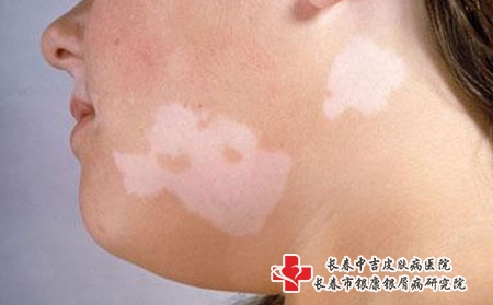 白癜风患者用药应谨防哪些问题?