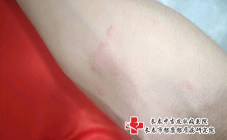长春荨麻疹的诱因都有哪些 长春荨麻疹的诱因都有哪些