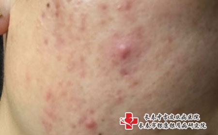 不同位置的青春痘意味着什么