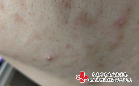 青春痘出现的原因都有哪些