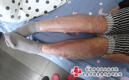 脓疱型牛皮癣如何护理