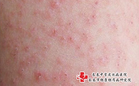 儿童容易患发哪些种类的荨麻疹