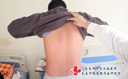 男性银屑病病人夏天该如何防备疾病复发?