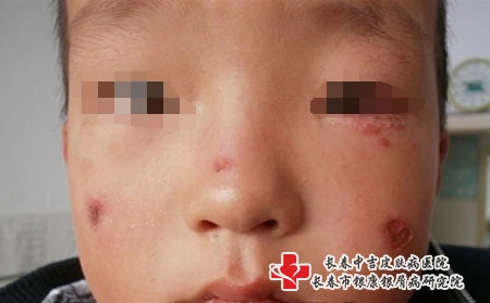 儿童患银屑病可以使用激素吗