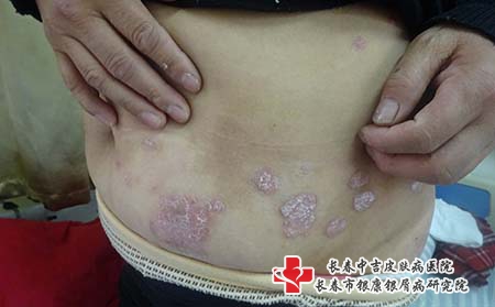 银屑病的高发人群是什么