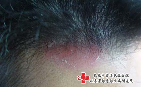 银屑病患者该怎么吃 银屑病患者该怎么吃