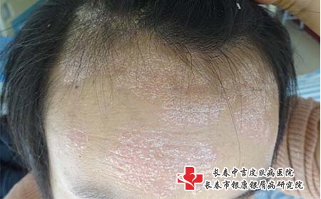 得了银屑病就没办法治疗了吗