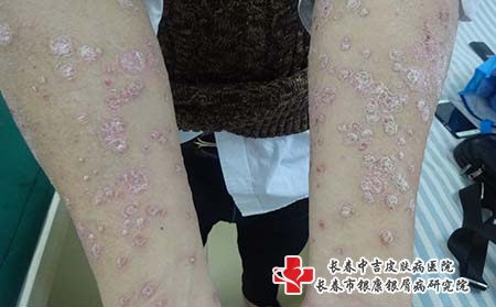 银屑病的治疗费用和康复要注意什么