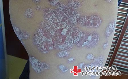 为什么会引起银屑病呢