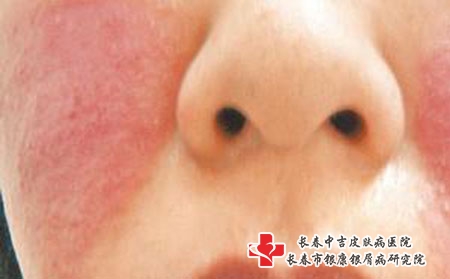 银屑病患者如何安全使用药物