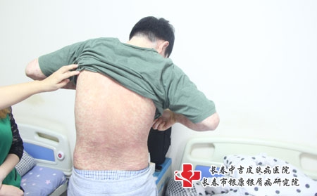 男性银屑病饮食的注意事项是什么 男性银屑病饮食的注意事项是什么