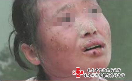 银屑病的危害是什么