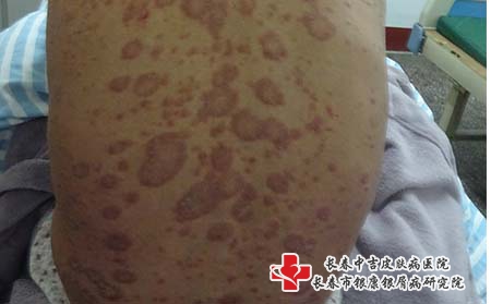 牛皮癣发病后症状表现如何?