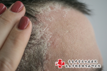 摄图网_503159049_头发上和头皮缝上有丝虫病(企业商用)_副本 摄图网_503159049_头发上和头皮缝上有丝虫病(企业商用)_副本