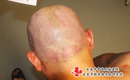 长春中吉牛皮癣医院效果如何?