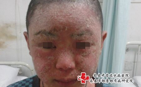 长春哪家医院是专业治疗牛皮癣的 长春哪家医院是专业治疗牛皮癣的