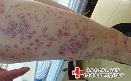牛皮癣患者不能吃什么