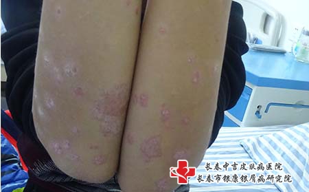 长春牛皮癣的治疗医院哪家好