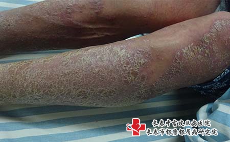 长春好的牛皮癣医院怎么选择呢?