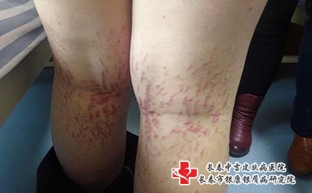 牛皮癣的护理要怎么做