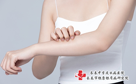 摄图网_501700721_皮肤过敏抓挠手臂的女性（企业商用）