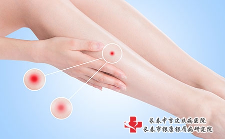 摄图网_500774826_皮肤发炎(企业商用) 摄图网_500774826_皮肤发炎(企业商用)