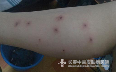 荨麻疹症状