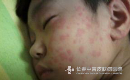 荨麻疹症状
