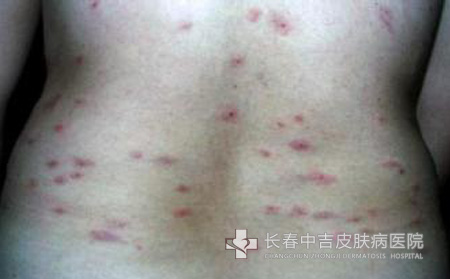 荨麻疹症状