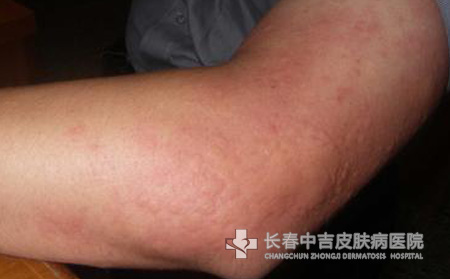 荨麻疹症状