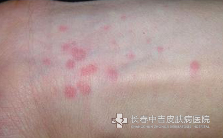 荨麻疹症状