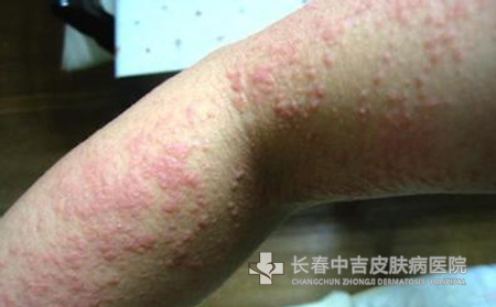 荨麻疹常见的症状有哪些