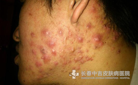 痤疮症状